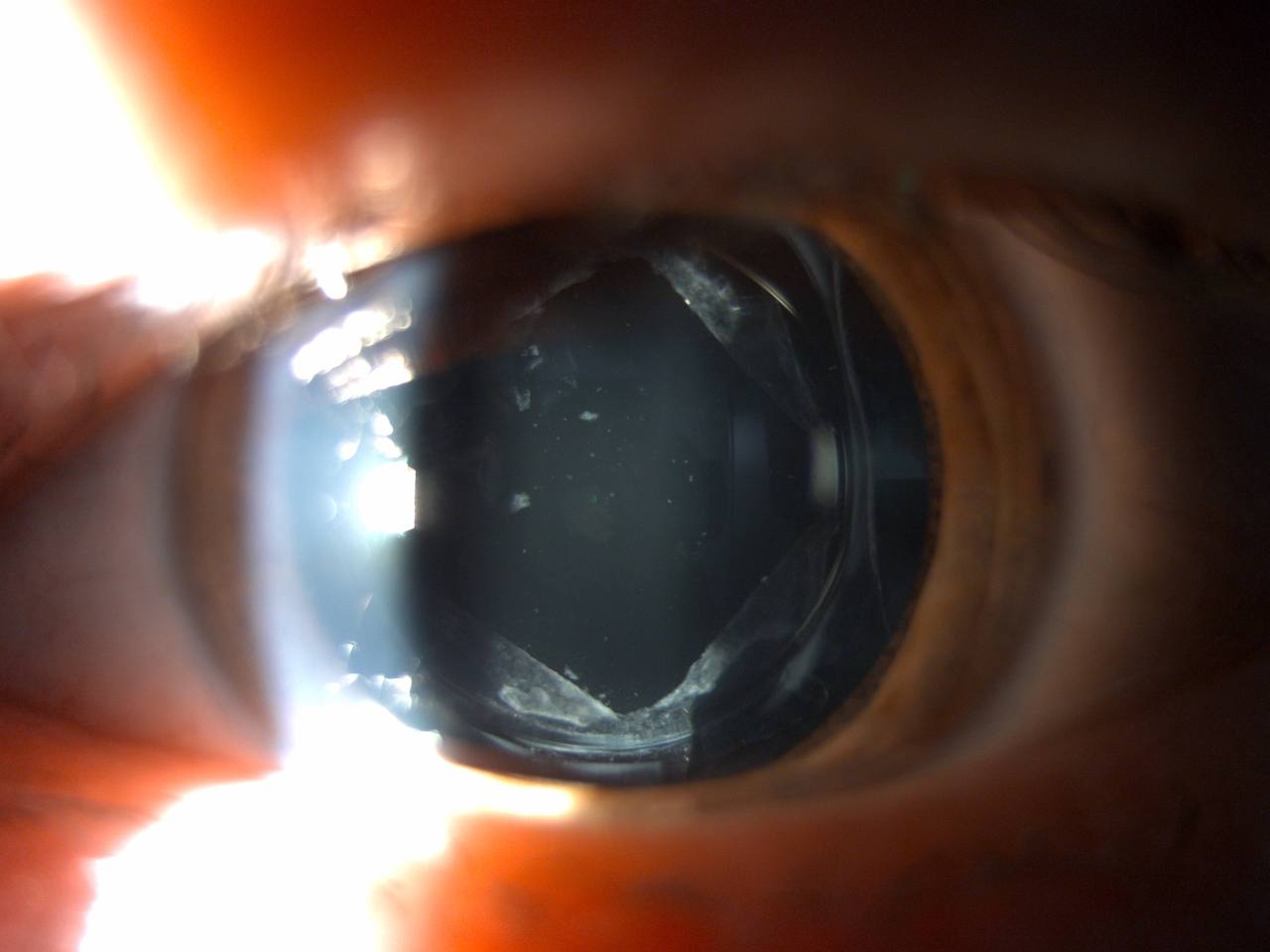 YAG-дисцизия вторичной катаракты.